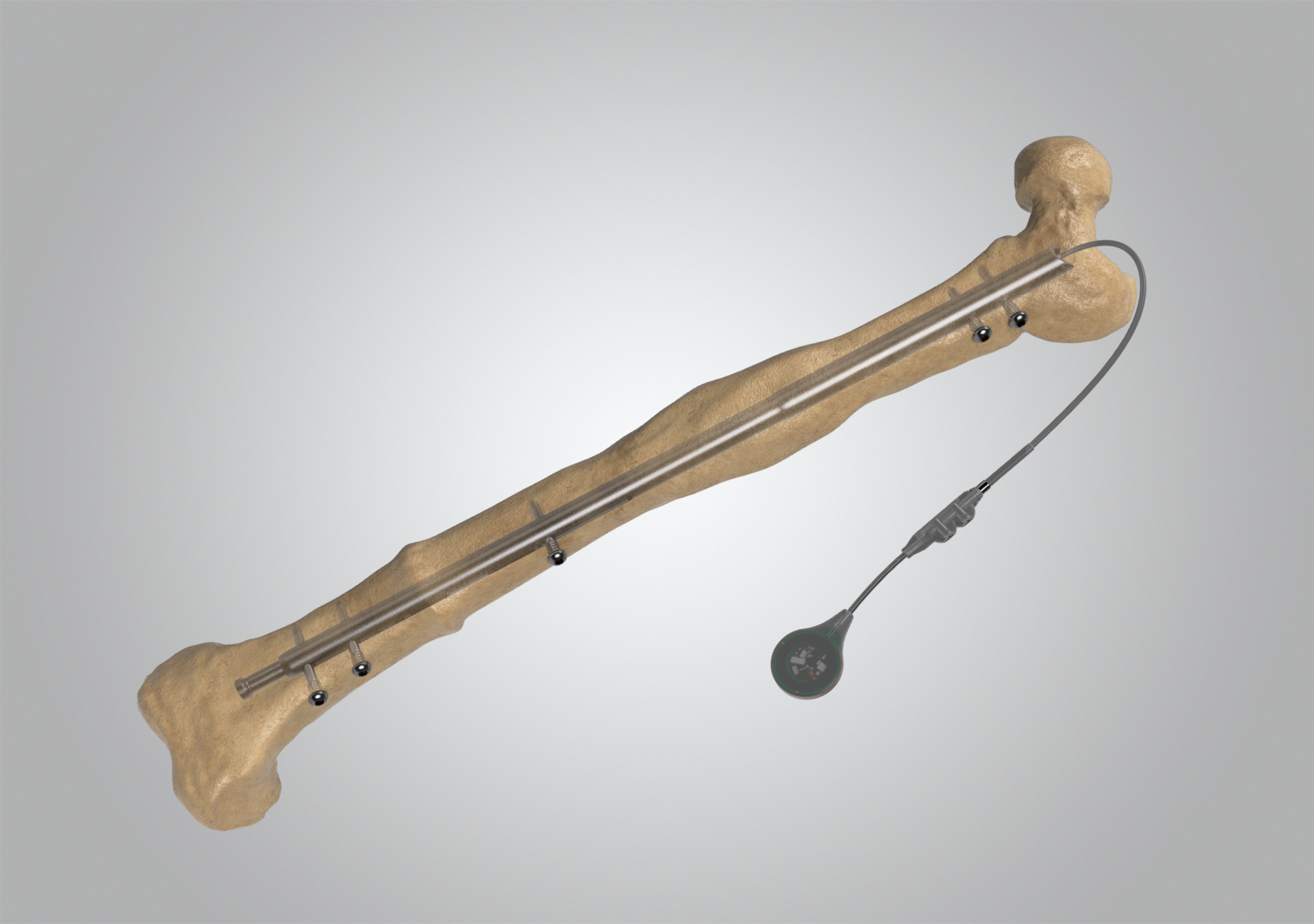Fitbone Method