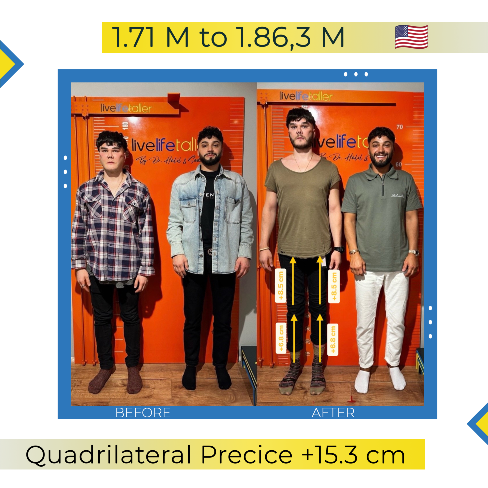 +15.3 cm Patient USA